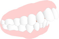 出っ歯（上顎前突）